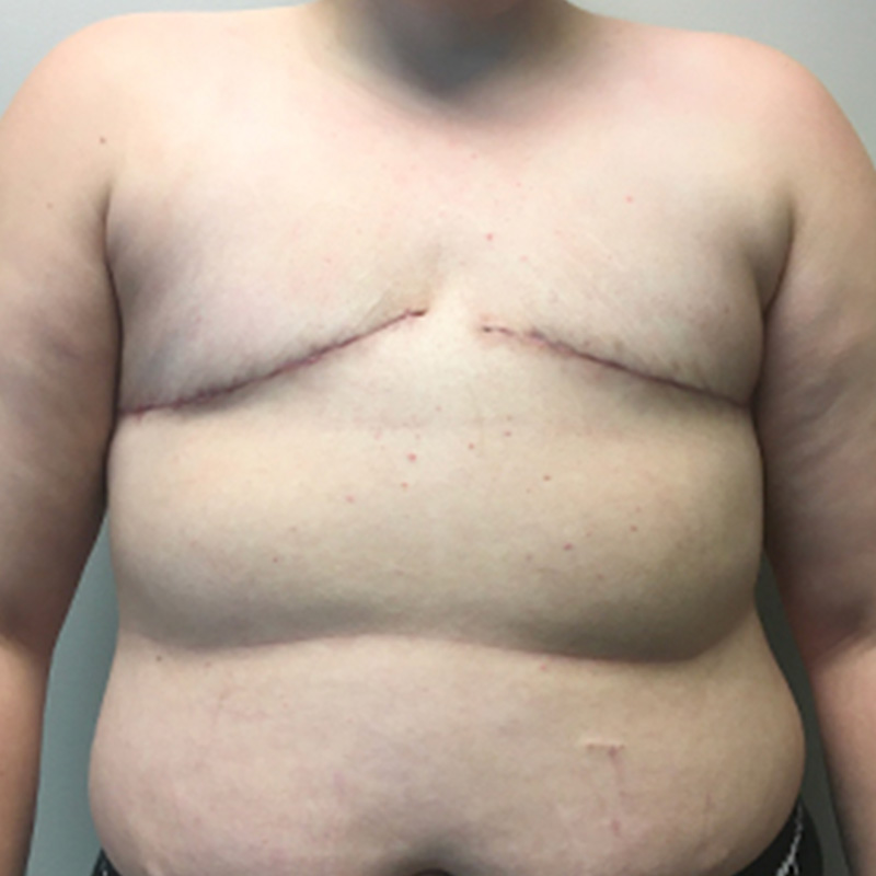 Female To Male Top Surgery 17