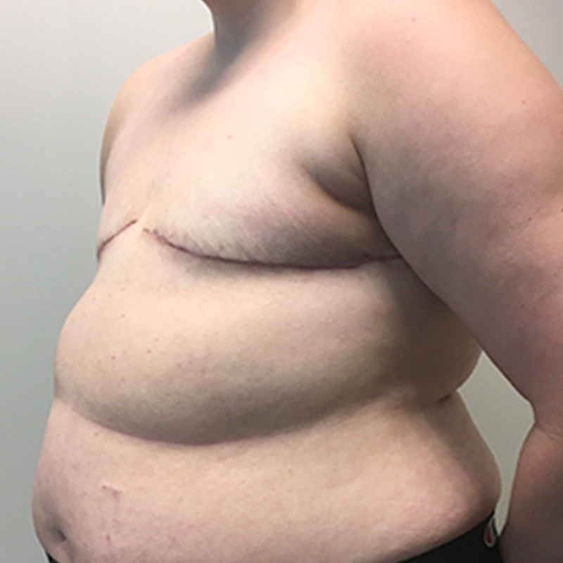 Female To Male Top Surgery 07