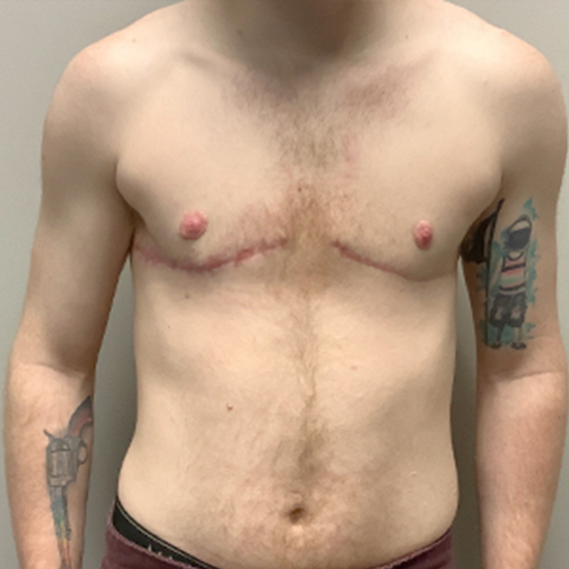 Female To Male Top Surgery 18