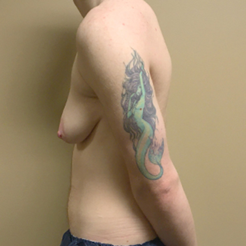 Female To Male Top Surgery 05