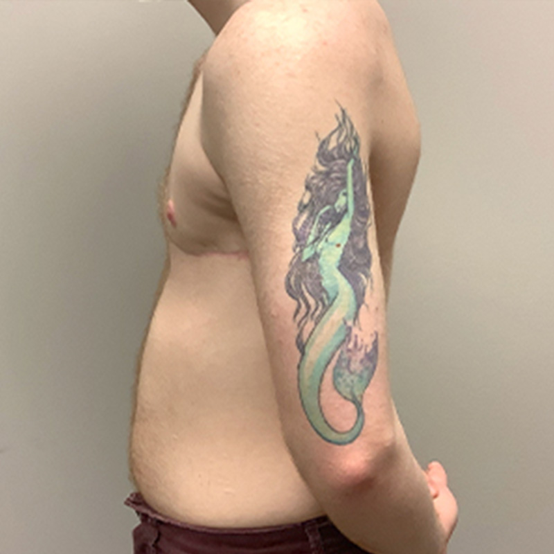 Female To Male Top Surgery 05