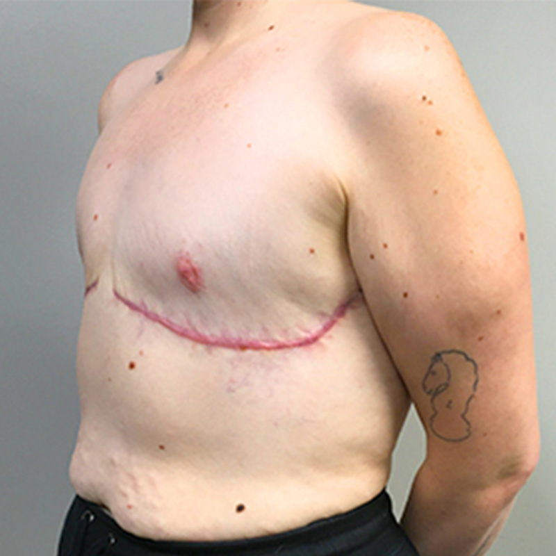 Female To Male Top Surgery 03