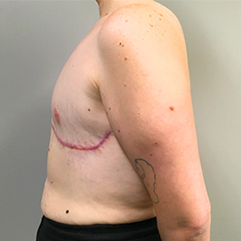 Female To Male Top Surgery 05