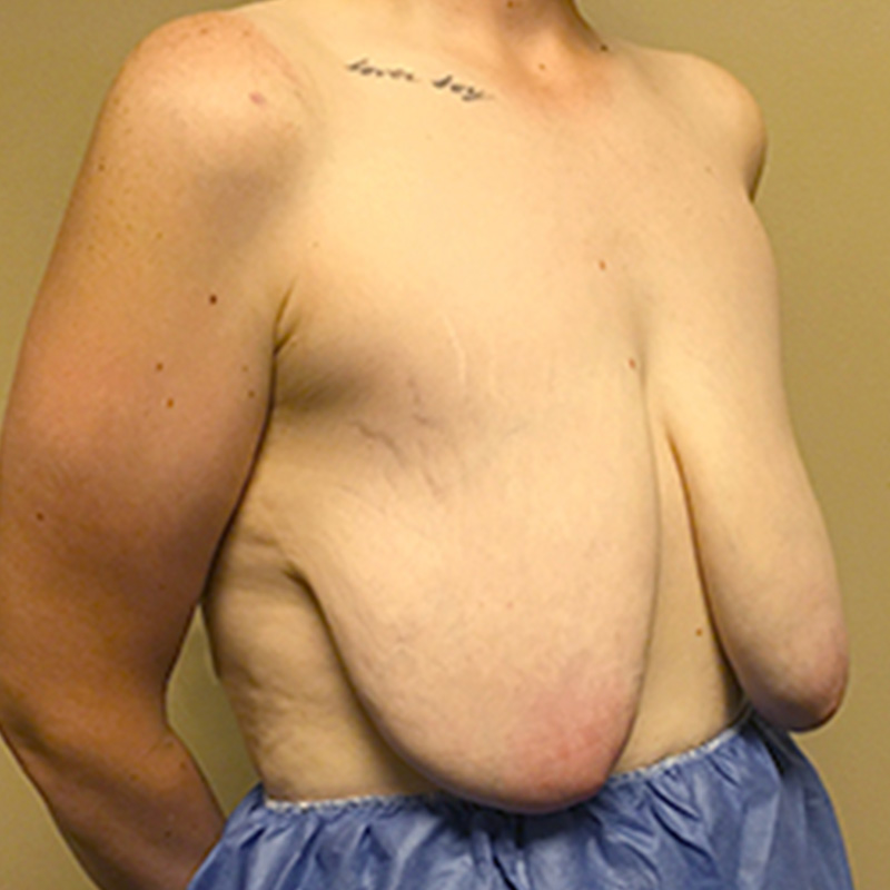 Female To Male Top Surgery 07