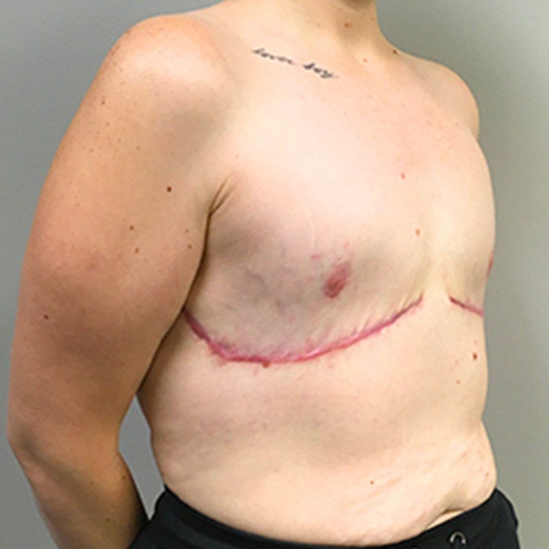 Female To Male Top Surgery 07