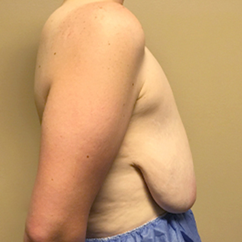 Female To Male Top Surgery 09