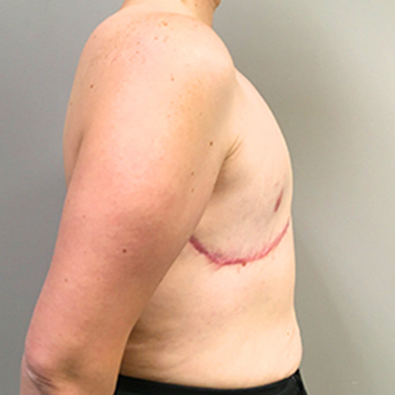 Female To Male Top Surgery 09