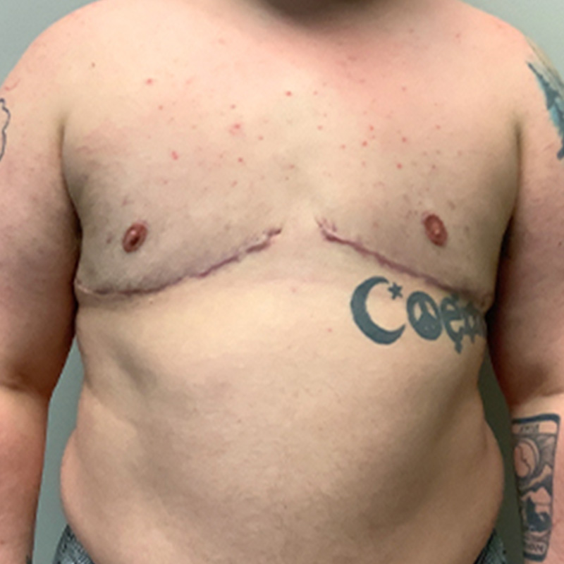 Female To Male Top Surgery 20