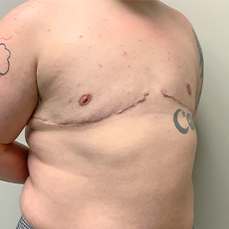 Female To Male Top Surgery 03