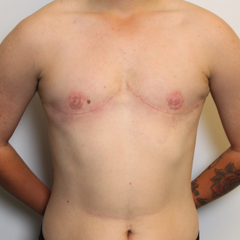 Female To Male Top Surgery 21