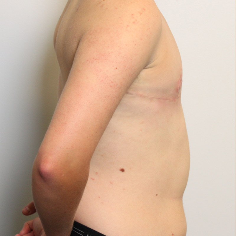 Female To Male Top Surgery 07
