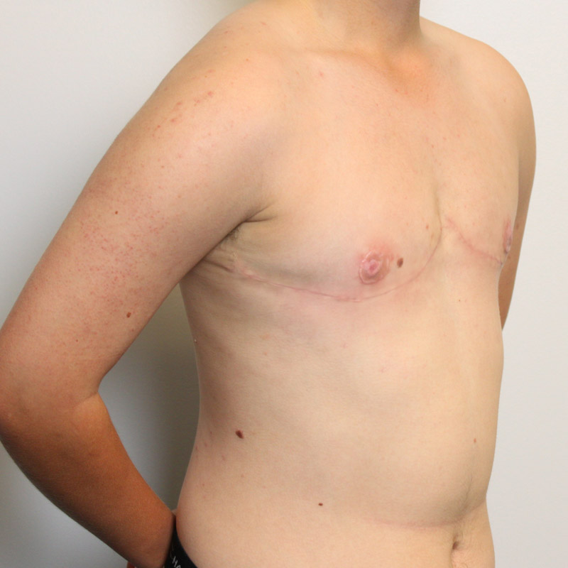 Female To Male Top Surgery 09