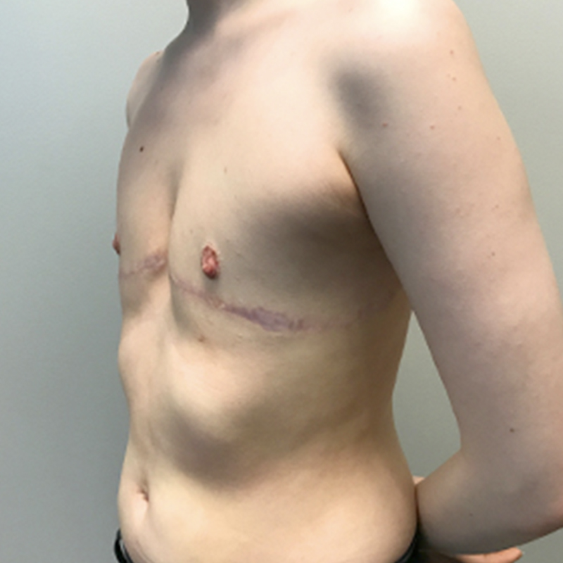 Female To Male Top Surgery 03