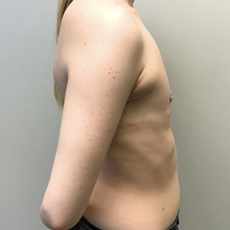 Female To Male Top Surgery 09