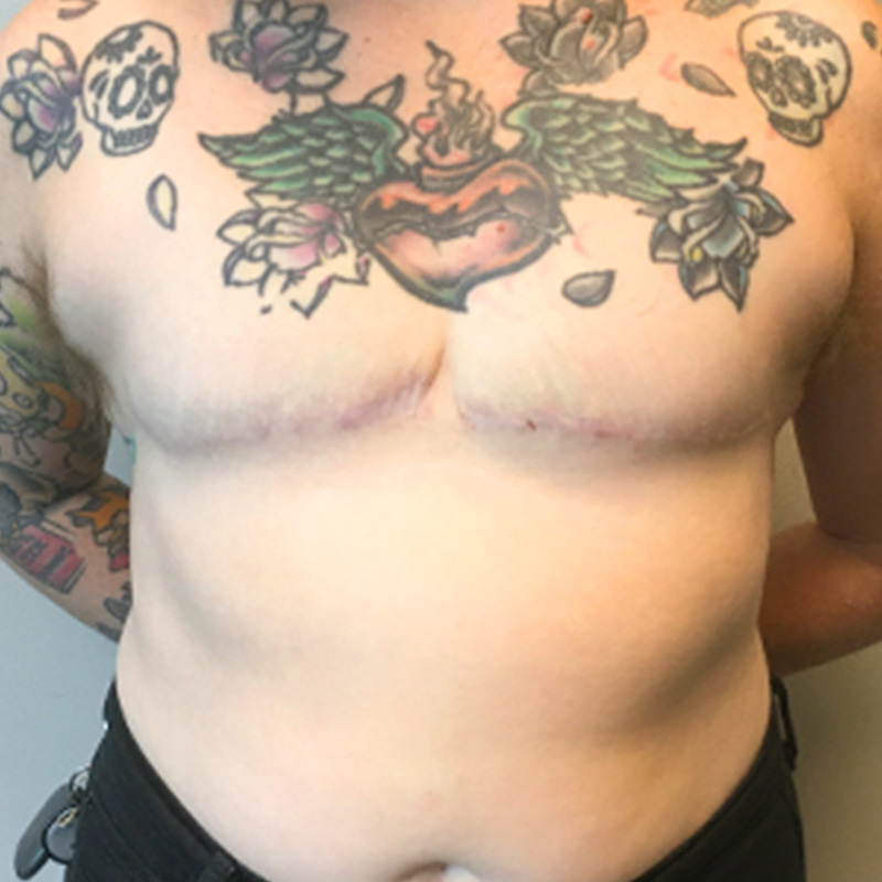 Female To Male Top Surgery 23