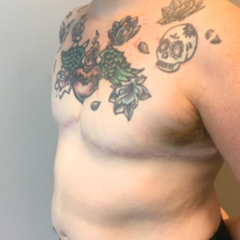 Female To Male Top Surgery 07