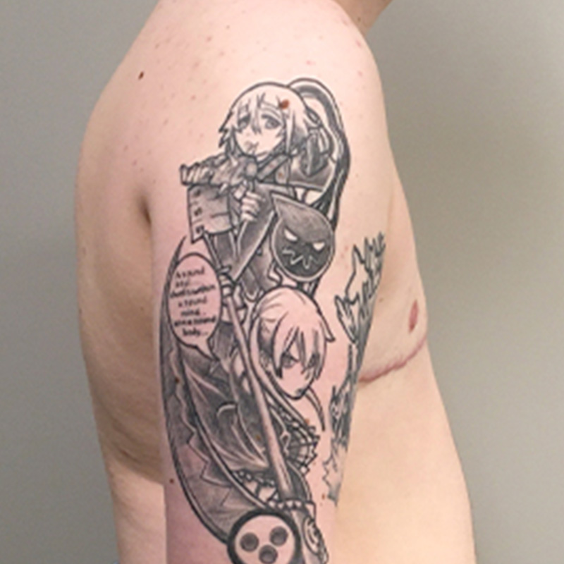 Female To Male Top Surgery 05