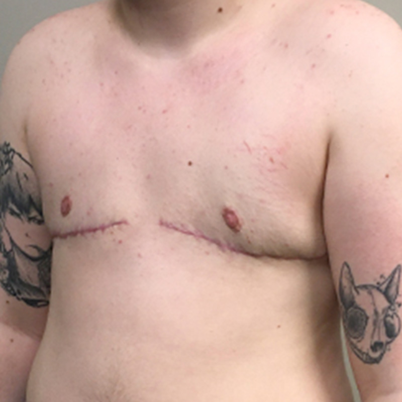 Female To Male Top Surgery 07