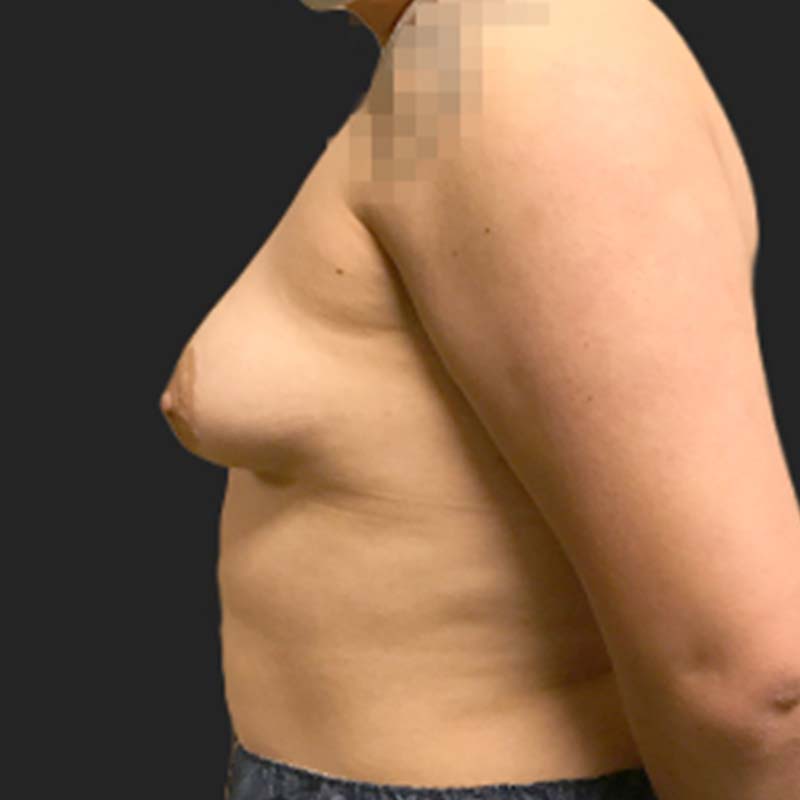 Female To Male Top Surgery 03