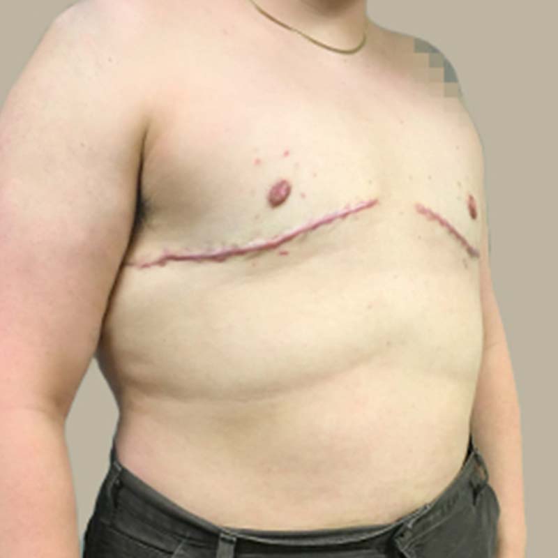 Female To Male Top Surgery 09