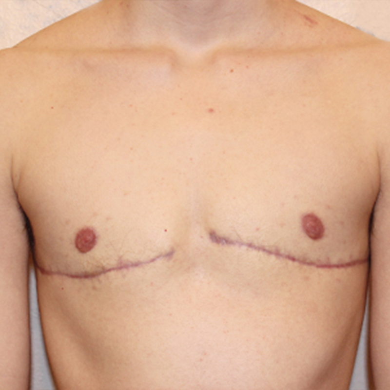 Female To Male Top Surgery 26