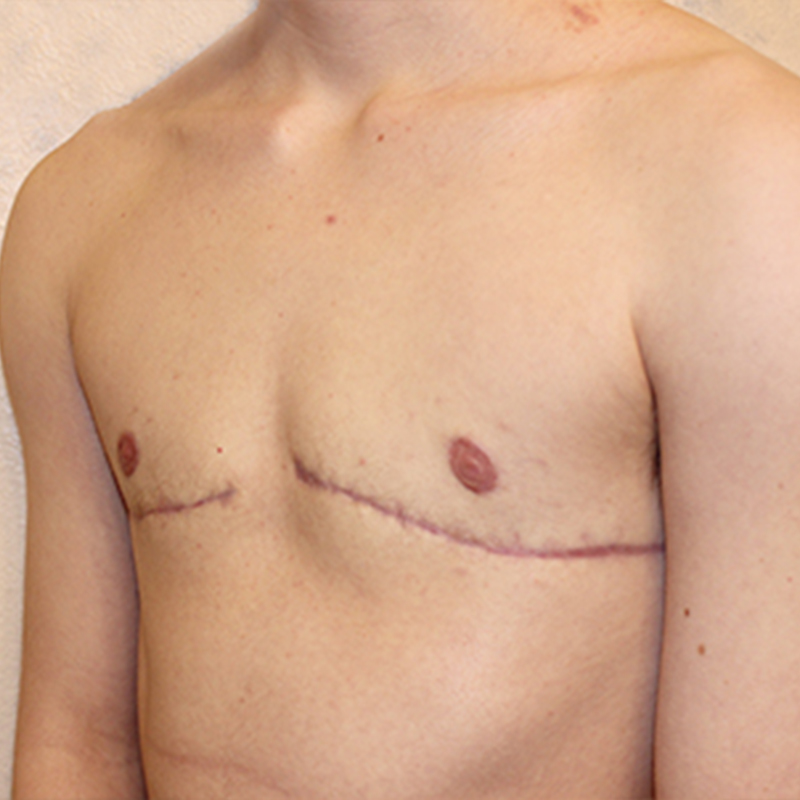 Female To Male Top Surgery 03