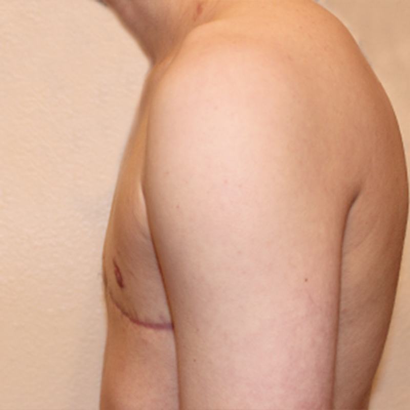 Female To Male Top Surgery 05