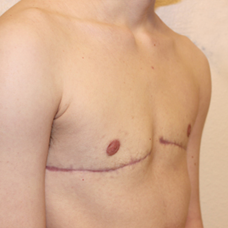 Female To Male Top Surgery 07