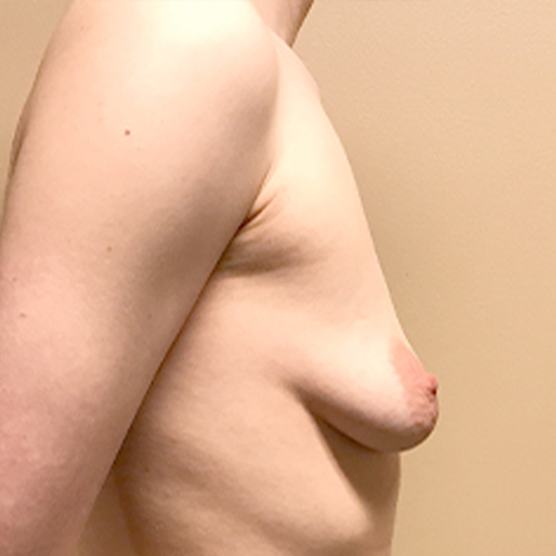 Female To Male Top Surgery 09