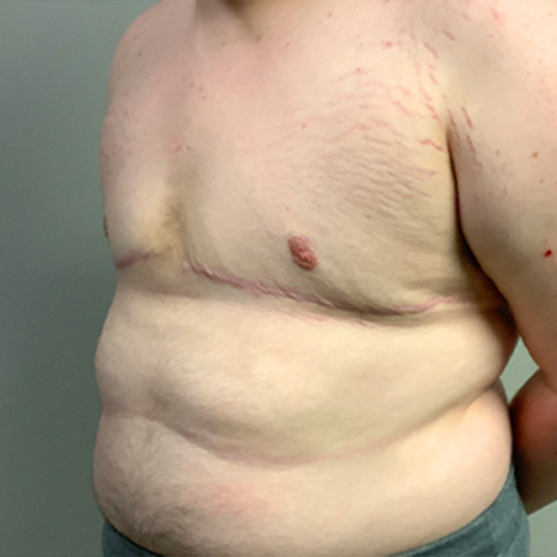 Female To Male Top Surgery 03