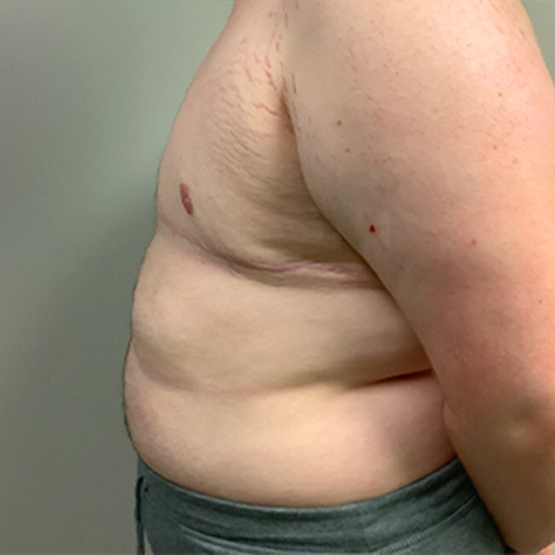 Female To Male Top Surgery 05