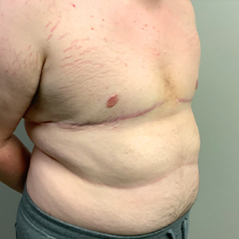 Female To Male Top Surgery 07