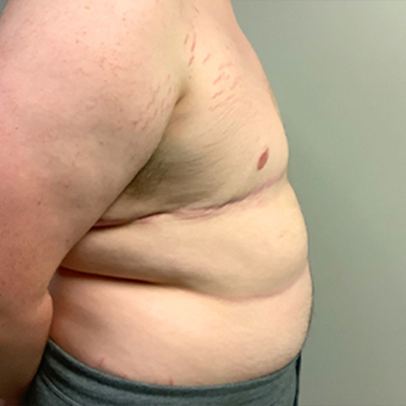 Female To Male Top Surgery 09