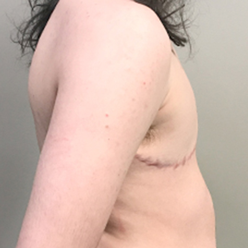 Female To Male Top Surgery 05