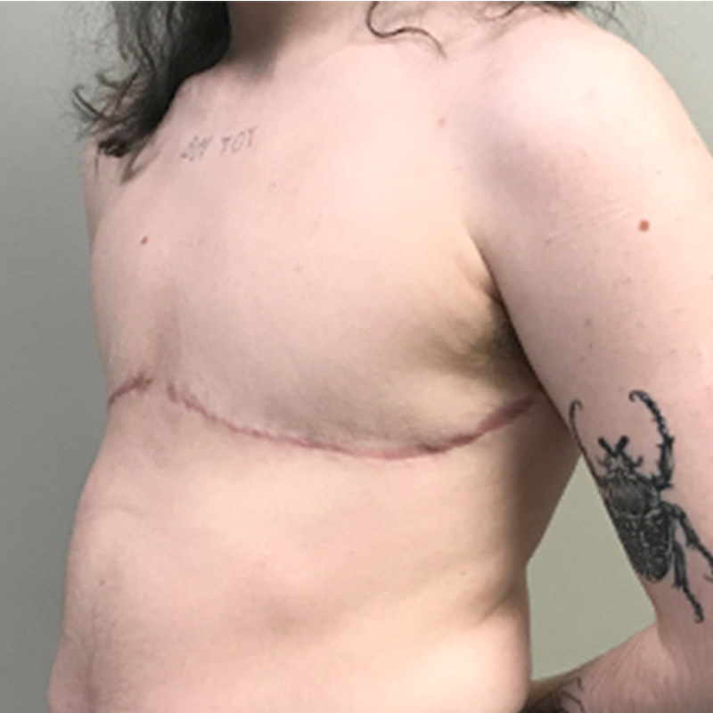 Female To Male Top Surgery 07