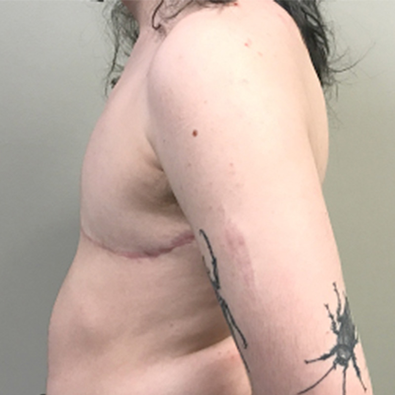 Female To Male Top Surgery 09