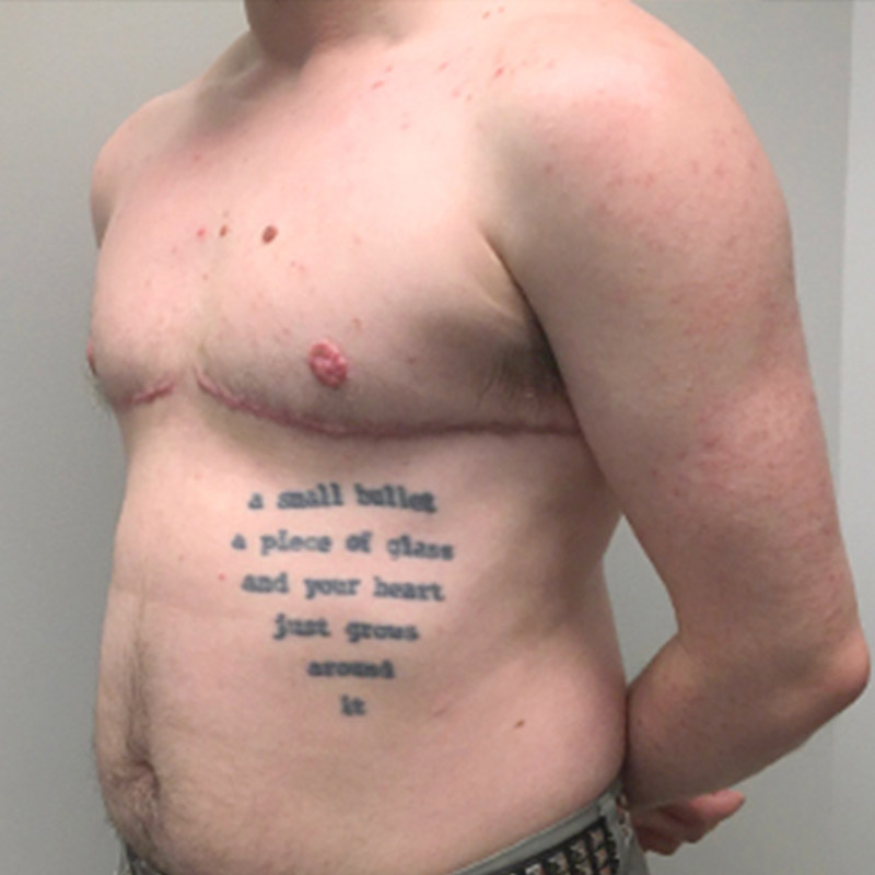 Female To Male Top Surgery 03