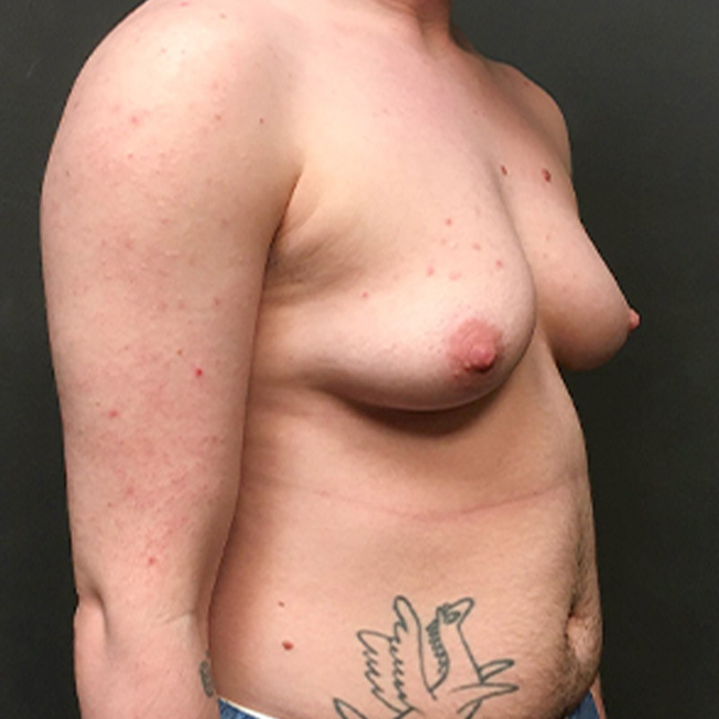 Female To Male Top Surgery 05