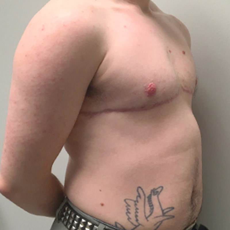 Female To Male Top Surgery 05