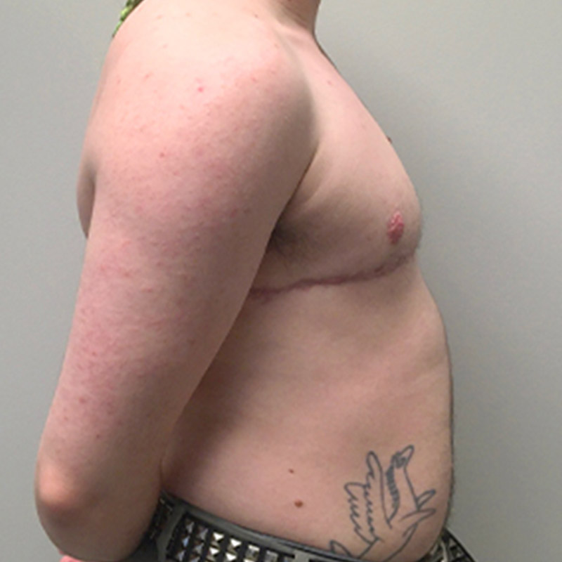 Female To Male Top Surgery 07