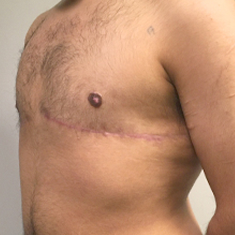 Female To Male Top Surgery 03