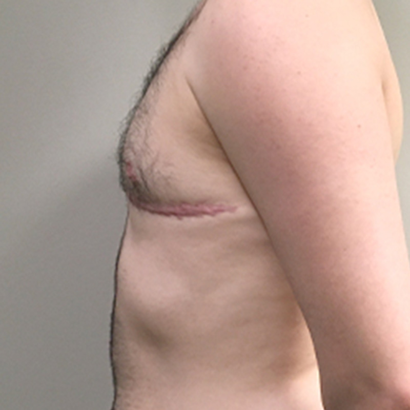 Female To Male Top Surgery 05