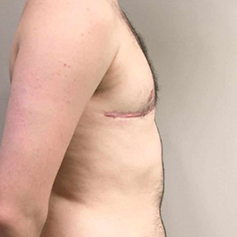 Female To Male Top Surgery 07