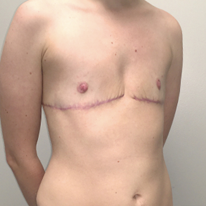 Female To Male Top Surgery 03