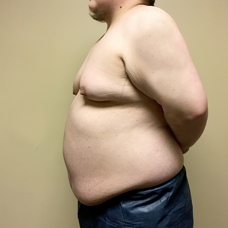 Female To Male Top Surgery 03