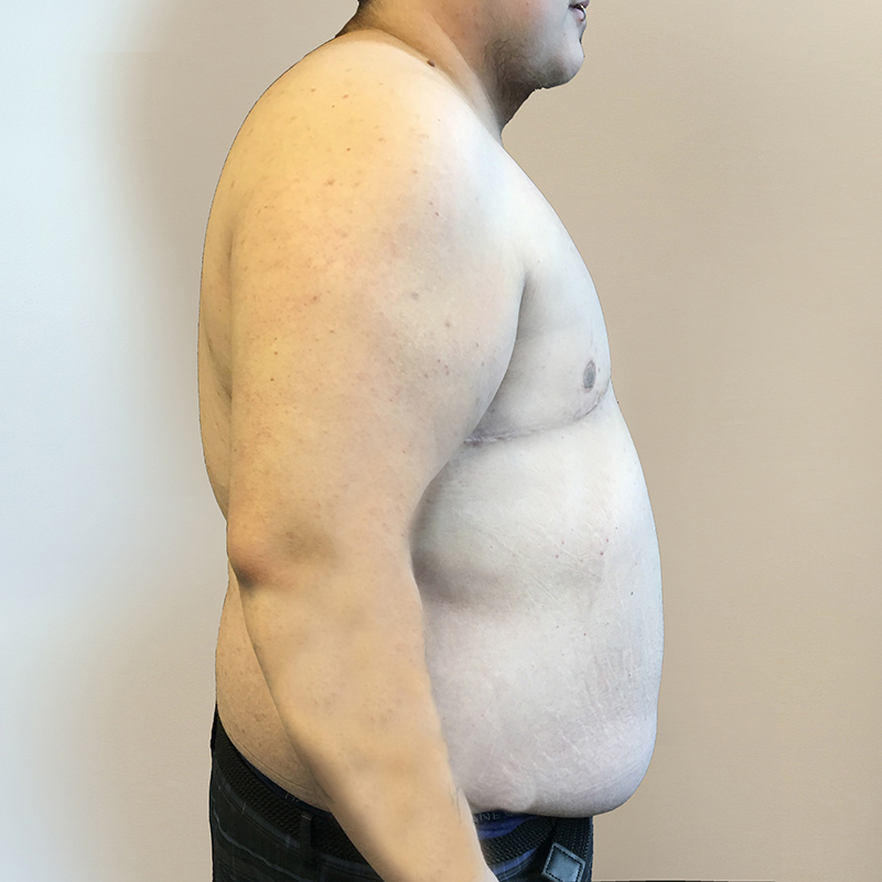 Female To Male Top Surgery 05