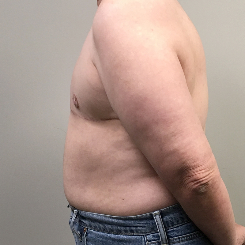 Female To Male Top Surgery 07