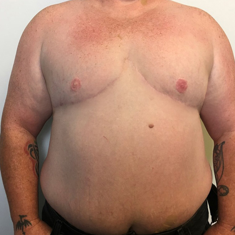 Female To Male Top Surgery 36