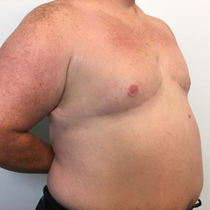 Female To Male Top Surgery 03