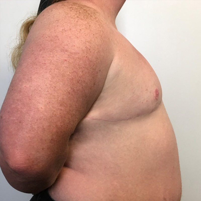 Female To Male Top Surgery 05